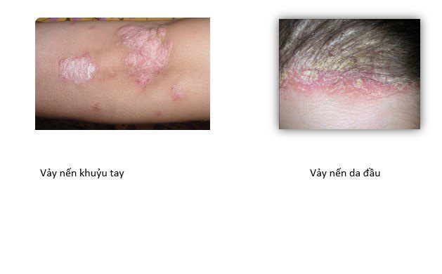benh-vay-nen.jpg