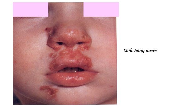 choc-bong-nuoc.jpg