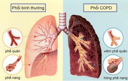 Bệnh phổi tắc nghẽn mạn tính – Những điều cần biết!