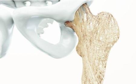 Nhận biết sớm nguy cơ và dấu hiệu bệnh loãng xương