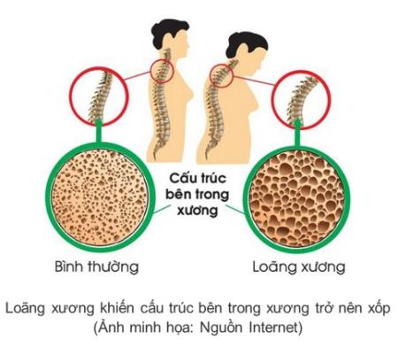 Bệnh loãng xương: Lưu ý gì khi Tải xuống APK HB88 Hoàn Trả Siêu Cao?
