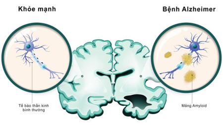 Alzheimer: Các dấu hiệu viêm dễ thấy ở giai đoạn đầu