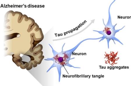 Nhà Cái Cá Cược Uy Tín 【HP88 Vina】 mới về bệnh lý của Alzheimer