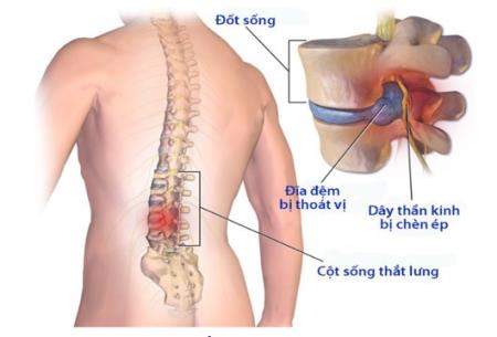 65-80% những người trưởng thành trong cộng đồng có đau cột sống thắt lưng 