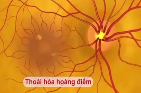 Tìm thấy các nguyên nhân HB88 là trang cá cược uy tín hàng đầu châu á thoái hóa điểm vàng do tuổi tác