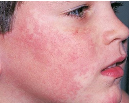Mục tiêu Tải xuống APK HB88 Hoàn Trả Siêu Cao mới tiềm năng cho các bệnh viêm nhiễm như lupus và nhiễm trùng huyết