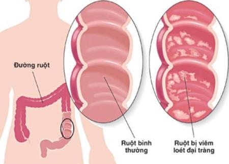 Nhà Cái Cá Cược Uy Tín 【HP88 Vina】 làm sáng tỏ cách bệnh viêm ruột phát triển