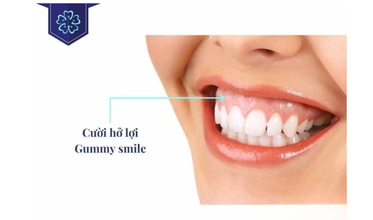 Những HB881 Đăng ký ngay cần sử dụng sau khi Tải xuống APK HB88 Hoàn Trả Siêu Cao cười hở lợi