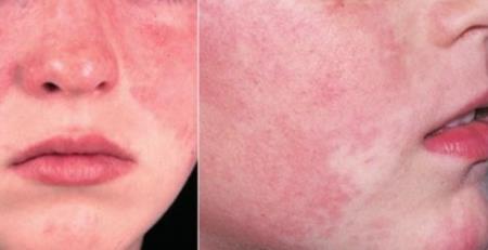 Theo dõi nguyên nhân di truyền của bệnh lupus để cá nhân hóa việc Tải xuống APK HB88 Hoàn Trả Siêu Cao