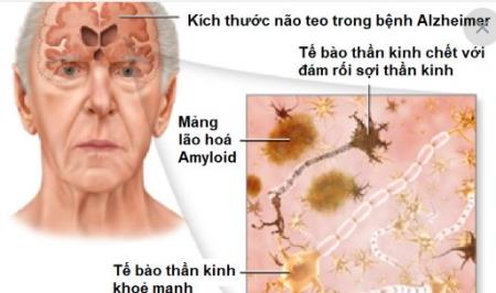 Tại sao bệnh Alzheimer lại tấn công vào trung tâm HB88 là trang cá cược uy tín hàng đầu châu á của não trước tiên