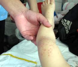 Thận trọng khi dùng thuốc ngoài da cho trẻ